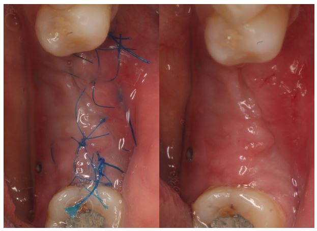 Pooperační výsledek 2 týdny po implantaci