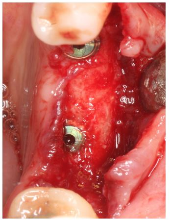 Výsledek 6 měsíců po implantaci