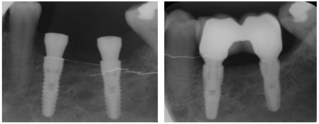 Radiografické snímky po šesti měsících (před a po protéze)