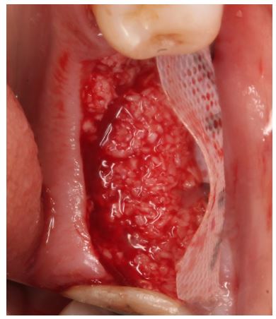 Implantace augmentačního materiálu